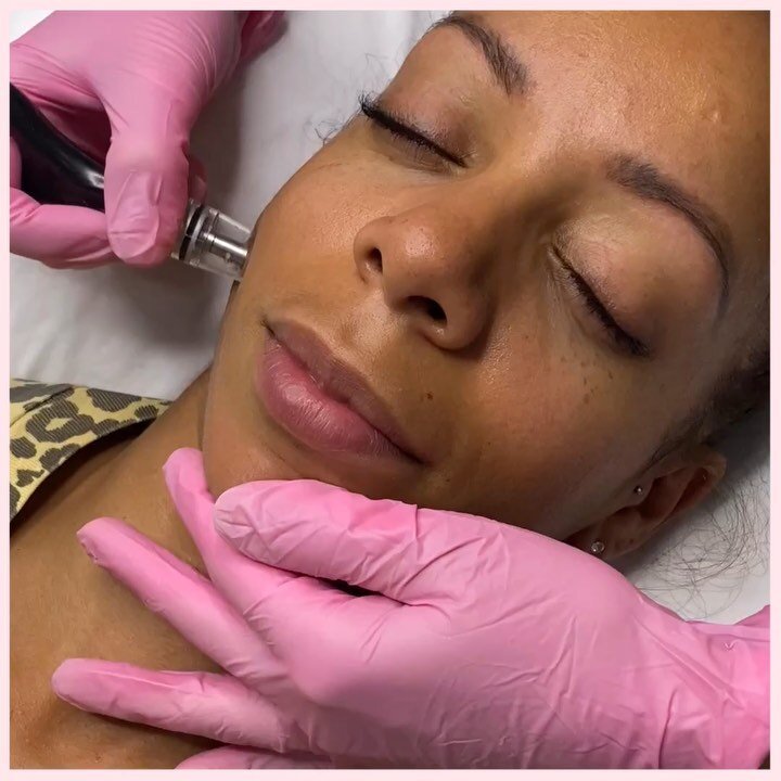 🖋D E R M A L I N F U S I O N 🖋 
⠀⠀
✔️ Non-invasive
✔️ No downtime
✔️ All skintones
✔️Treats hyperpigmentation, dry skin, photo-damage, and acne
⠀⠀
⏰ Time: 50 minutes
💉 Pain Level: none
🔢Sessions recommended: 3-5 for optimal results
🗒Consultation