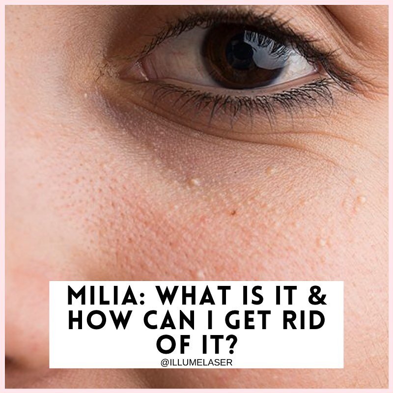 ⚪️ MILIA ⚪️ Do you have pesky white bumps under your eyes? SWIPE to find out what they are, how to get rid of them &amp; how to prevent them!