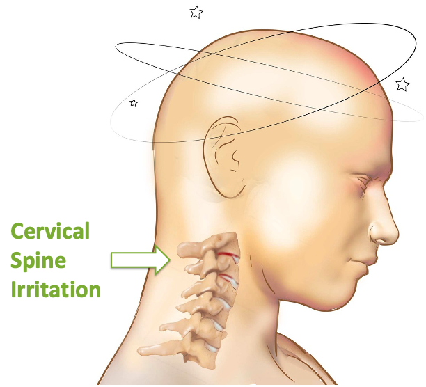 Vertigo &amp; Dizziness Relief in Burnaby, BC: Could Your Upper Neck Be the Missing Piece?
