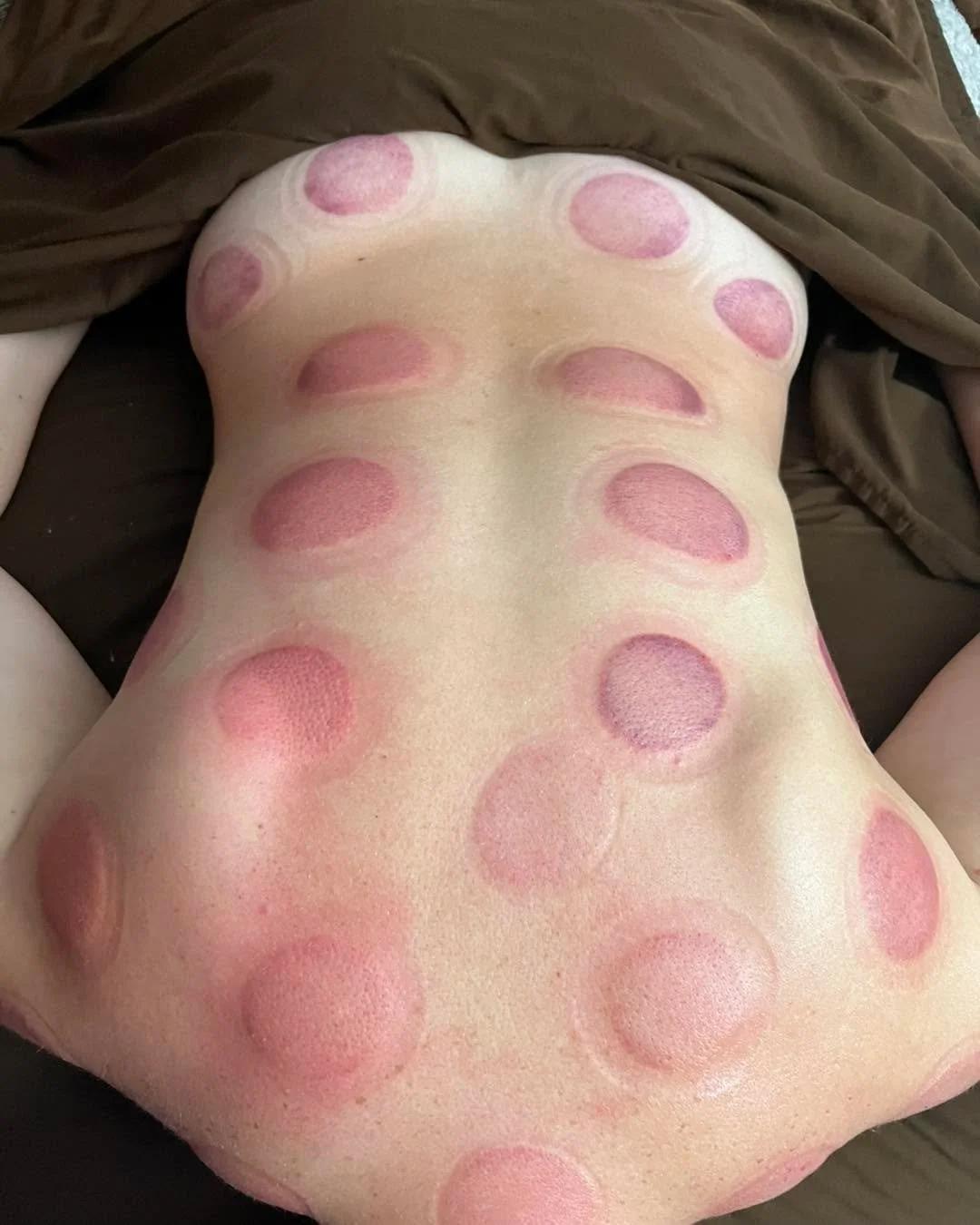 It&rsquo;s been a longgggg time since I&rsquo;ve talked about cup marks on here 🥹

What is cupping!? Essentially, a reverse deep tissue treatment pulling up and creating suction that separates the layers of muscle and fascia allowing stagnant blood 
