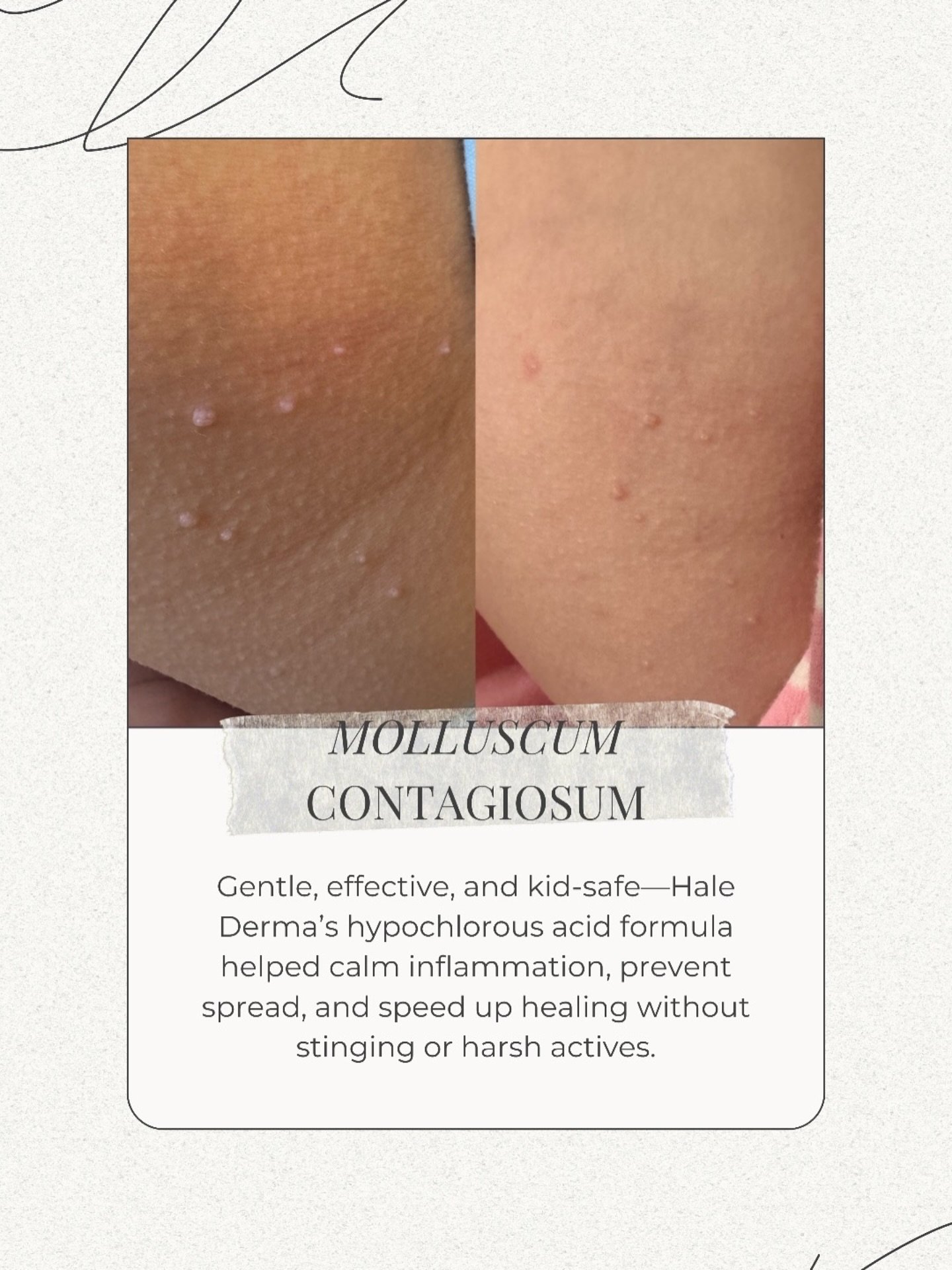 Before ➡️ After: Molluscum Contagiosum
Gentle, effective, and kid-safe&mdash;Hale Derma&rsquo;s hypochlorous acid formula helped calm inflammation, prevent spread, and speed up healing without stinging or harsh actives.
⠀⠀⠀⠀⠀⠀⠀⠀⠀
🧼 Antimicrobial + a