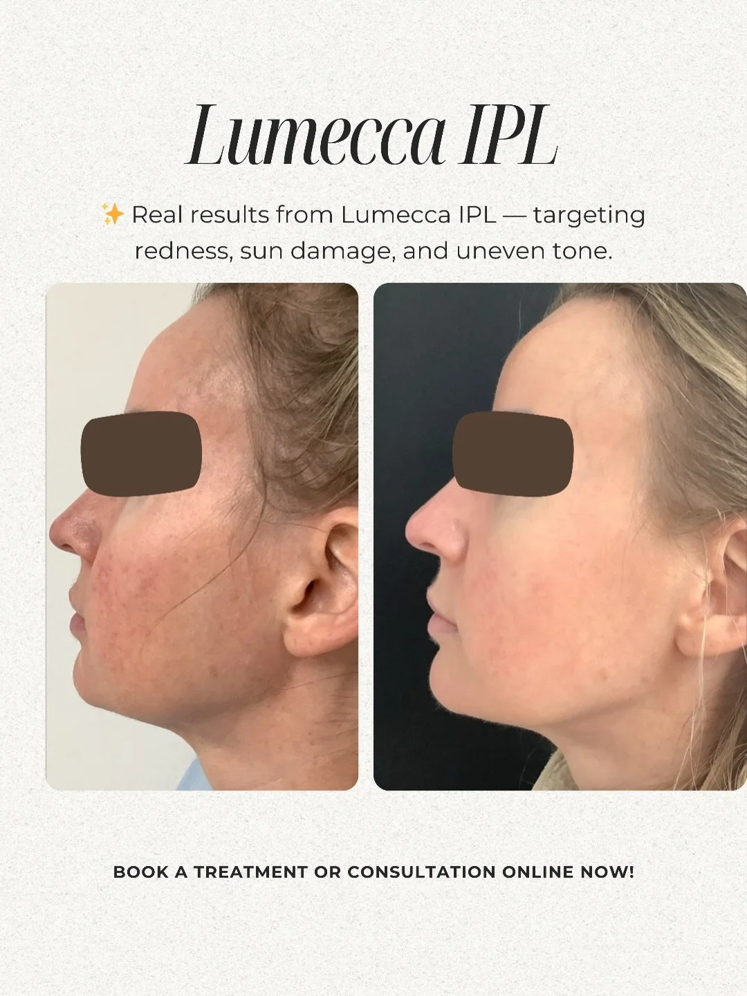 Results shown after ONE treatment.
⠀⠀⠀⠀⠀⠀⠀⠀⠀
Redness, sun damage, and uneven tone are some of the most common skin concerns we see - and Lumecca IPL is one of our go-to treatments for addressing all three ✨
⠀⠀⠀⠀⠀⠀⠀⠀⠀
This treatment uses intense pulse