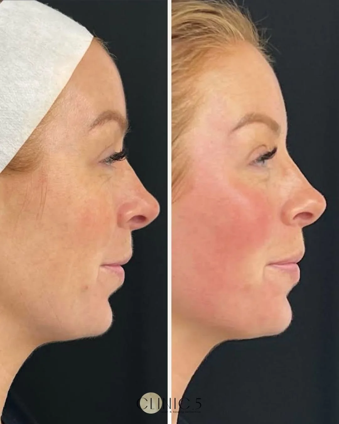 comox-valley-medi-spa-forma-facial-before-after.jpg