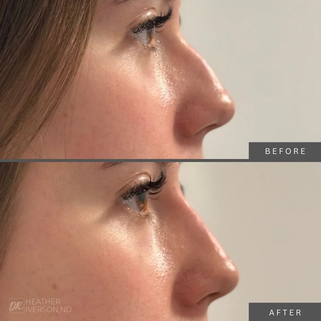 Side-by-side comparison of a woman's nose before and after a cosmetic procedure, showing a smoother nose shape in the 'after' image.