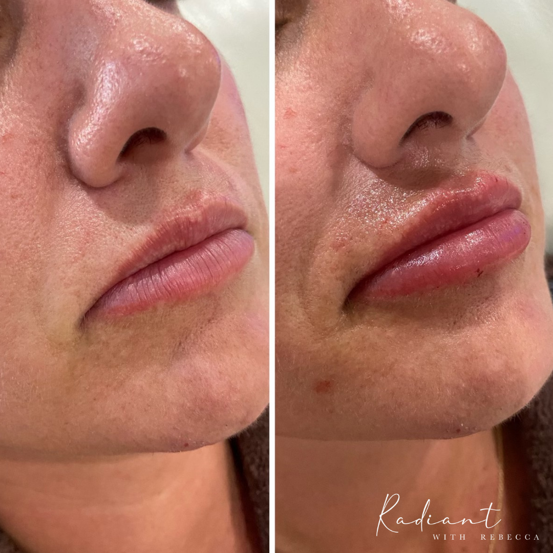 Lip Filler — Radiant with Rebecca Let your true beauty SHINE!