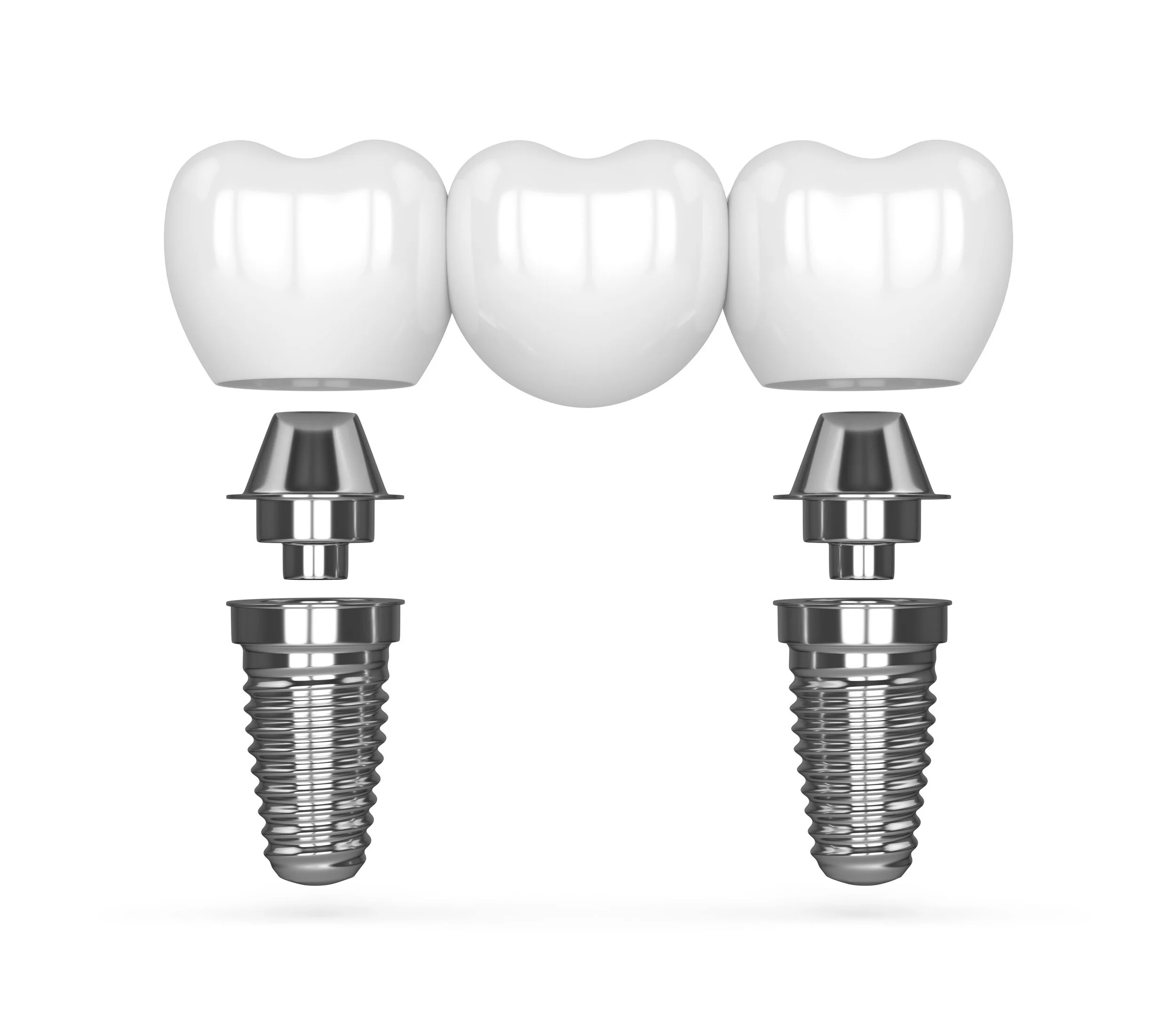 Cost of Dental Implants — NASHVILLE DENTURES AND IMPLANTS