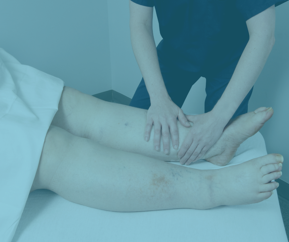 Lymphedema: What is it? And What You Can Do About it!