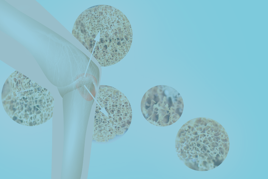 Bone Health - Be Too Fit to Fall or Fracture