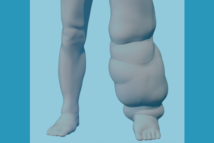 Is it Lymphedema or Lipedema?&nbsp;