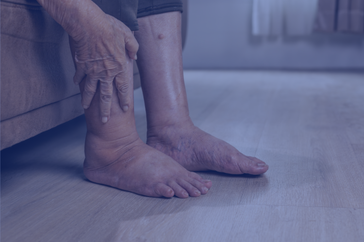 Take Control of Swelling and Discomfort with Lymphedema Care in Chantilly