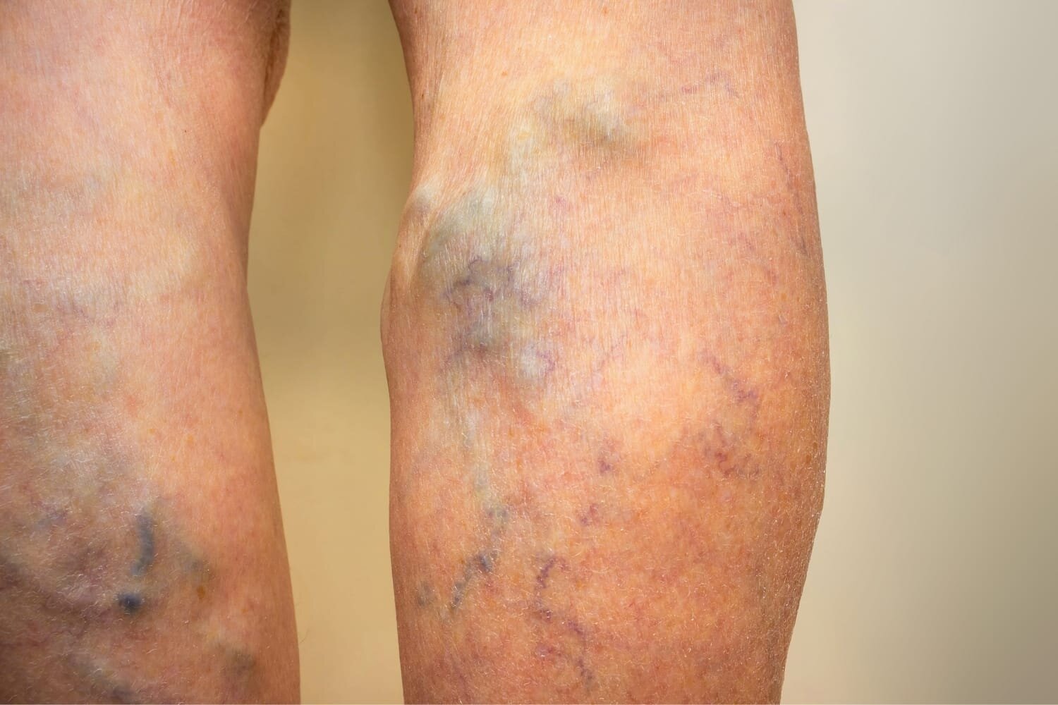 The Difference Between Varicose And Spider Veins - The Vein Institute