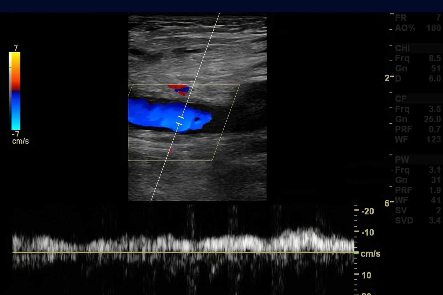 Venous Duplex Ultrasound Test in Naples, FL Naples Cardiac