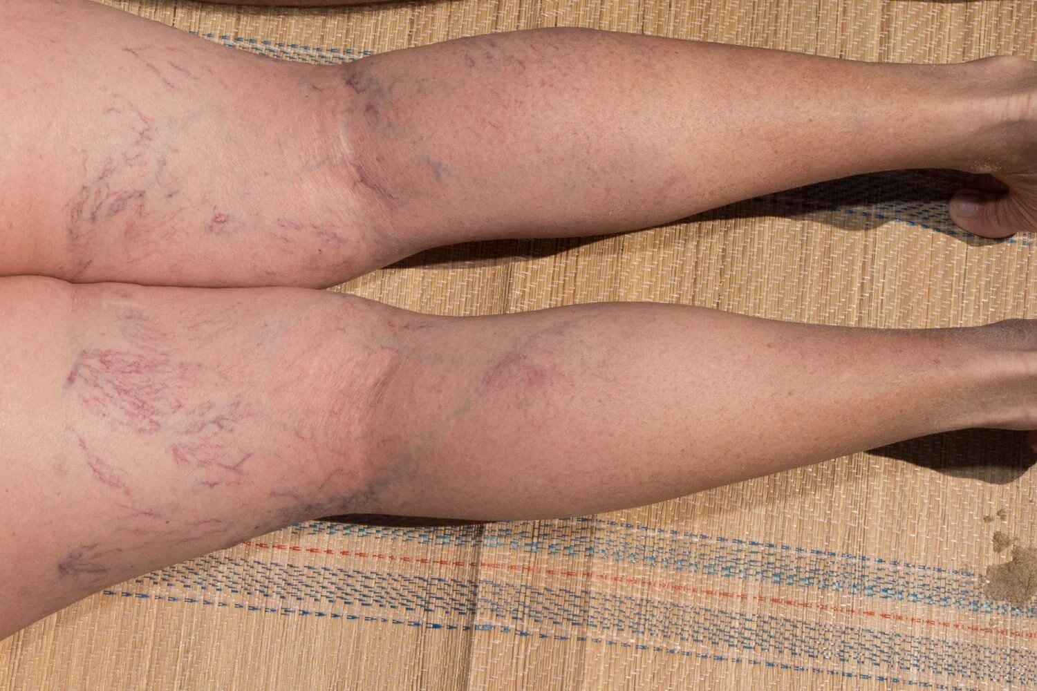 What Causes Spider Veins?  Naples Cardiac & Endovascular Center