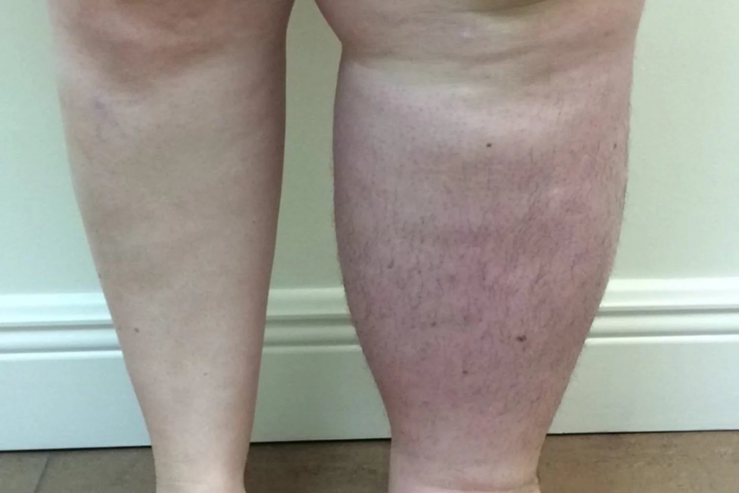 Lymphedema Causes One Leg Larger  Naples Cardiac & Endovascular