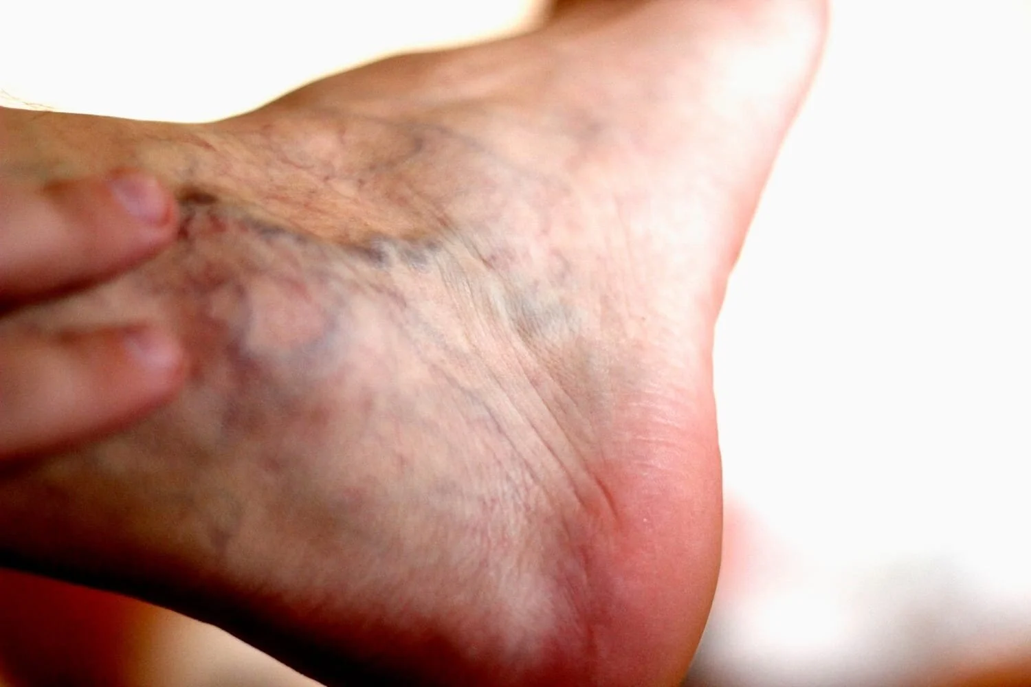 Understanding Varicose Veins in the Feet