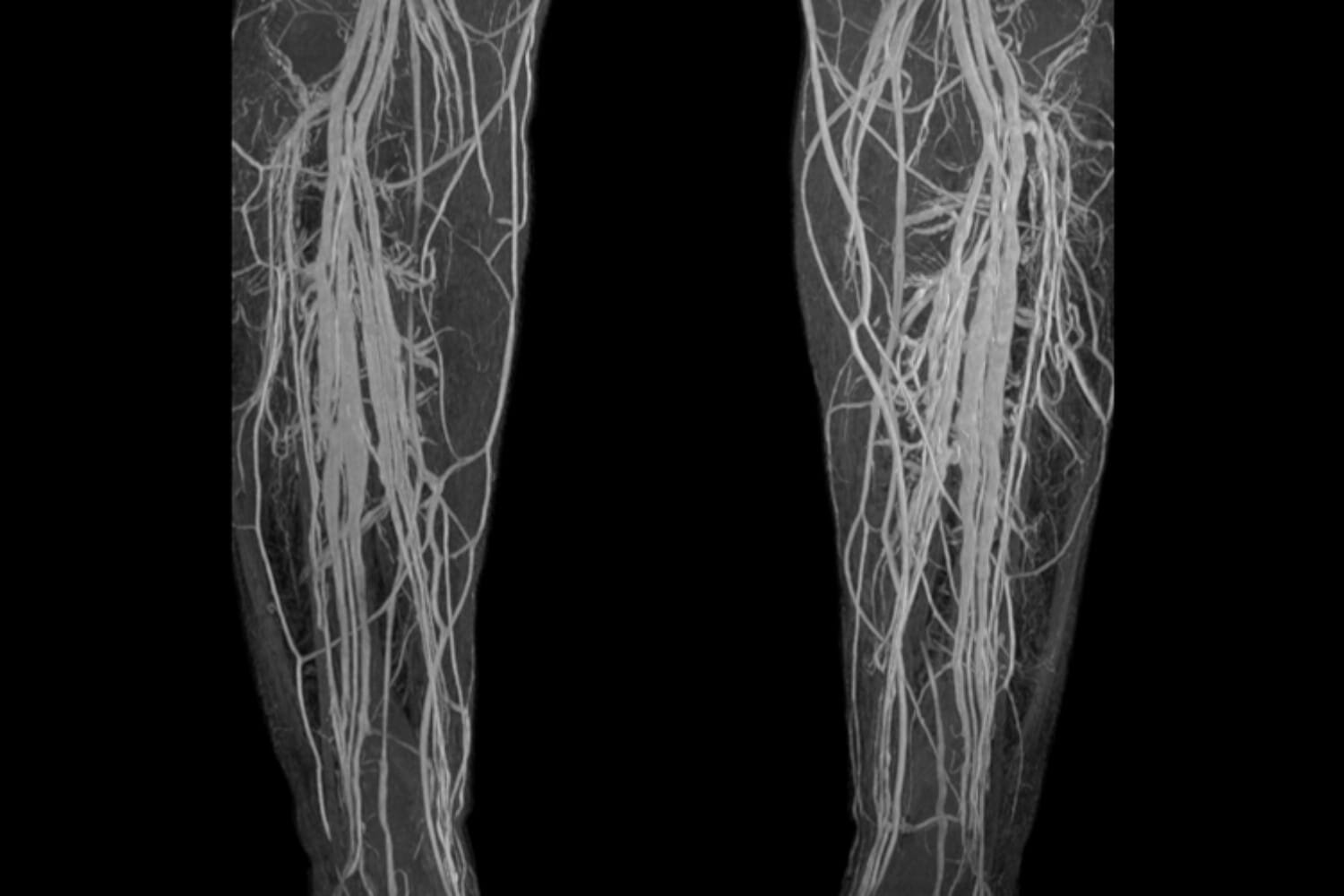 Lower Extremity Venogram Naples Cardiac & Endovascular Center