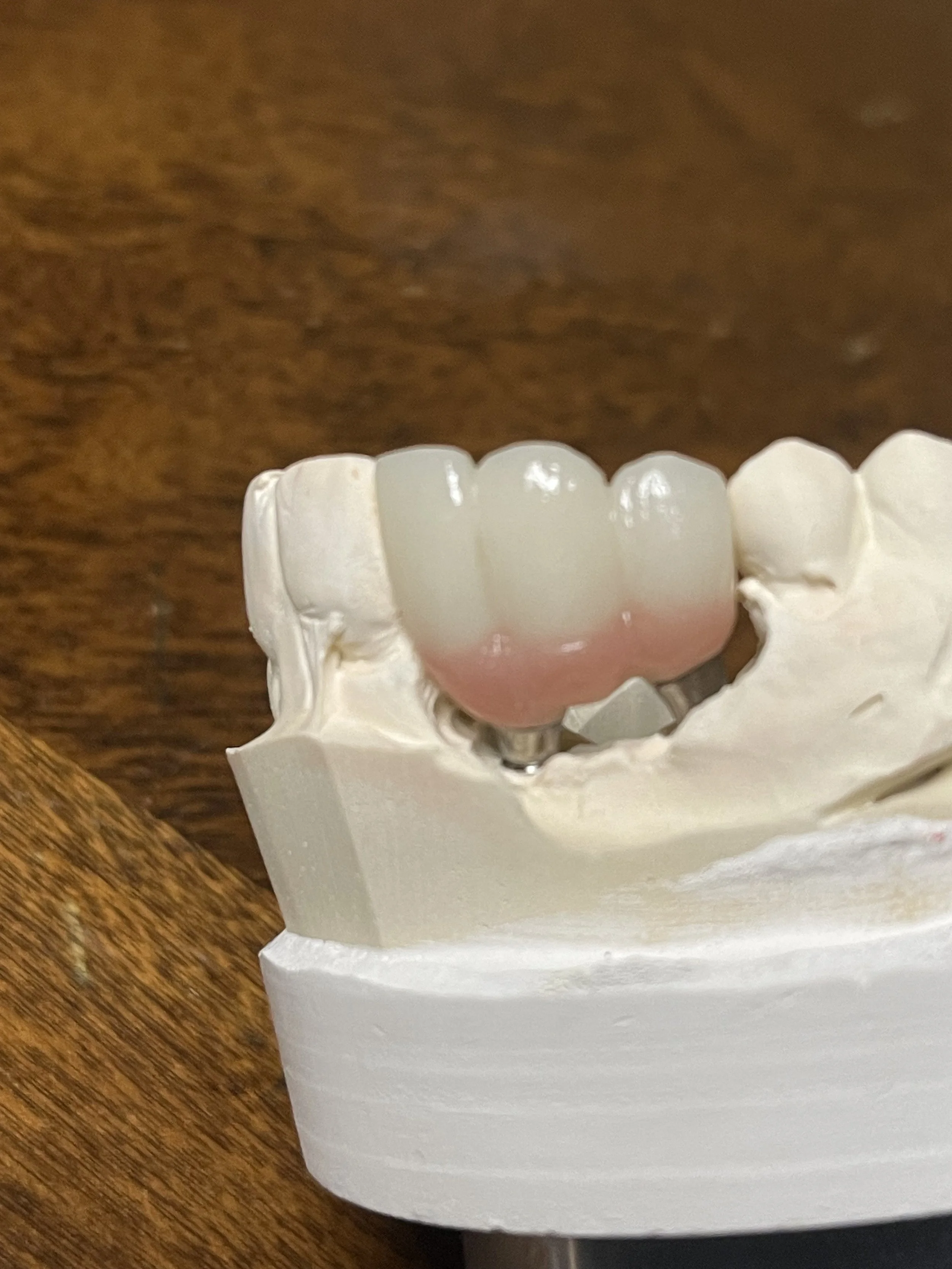 cosmetic bridge 