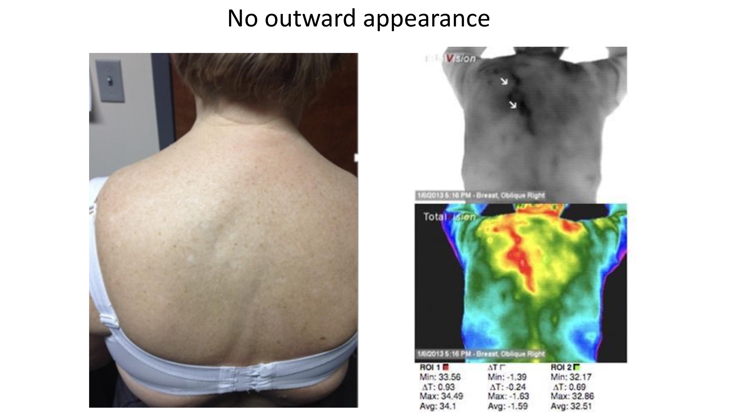 Breast Cancer & Thermography Presentation_3-13-2021_00019.png