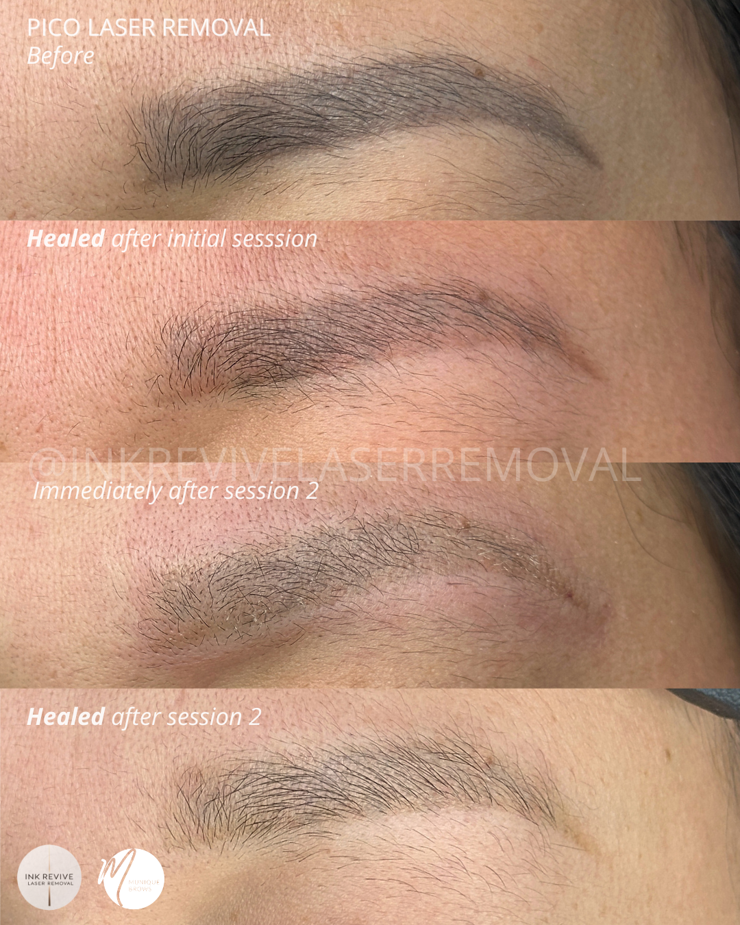 Pico Laser Removal for Over-Saturated Powder Brows