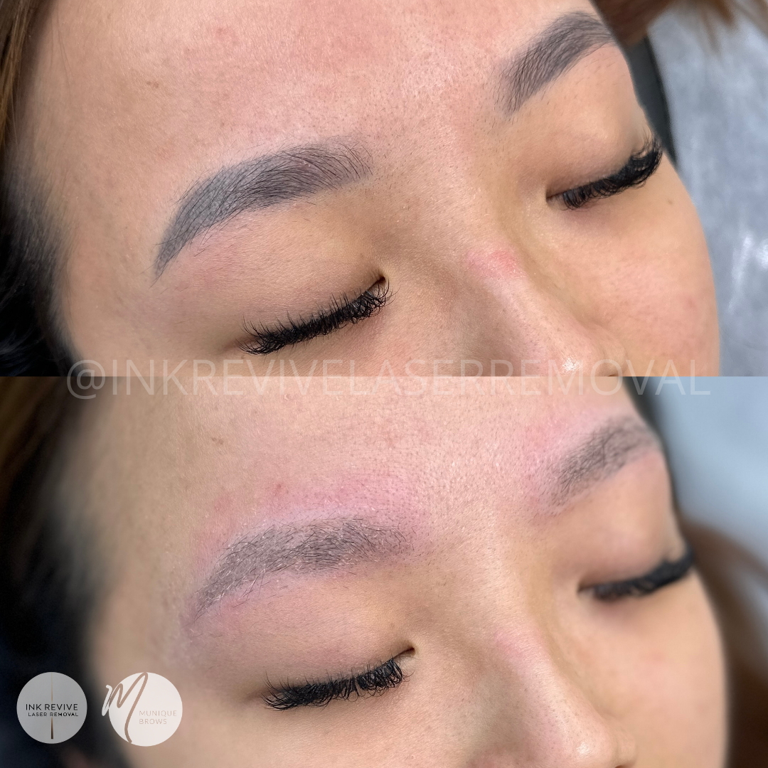 Still Waiting for Your Brows to Fade? Why 3+ Year Old PMU Needs a Pico Laser Reset
