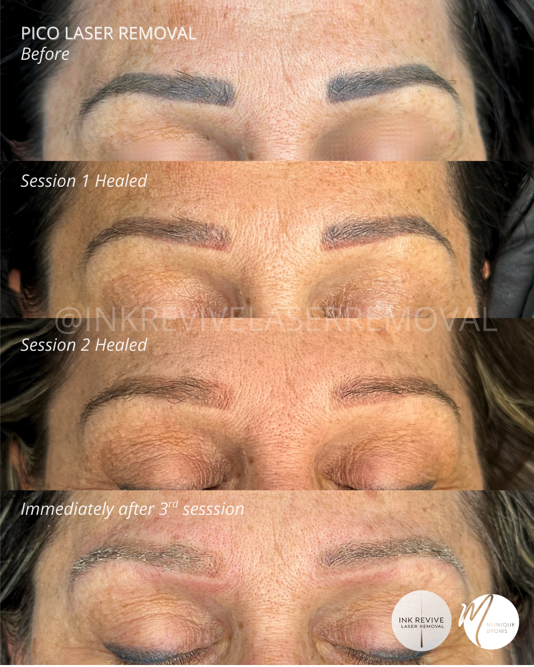 When "Fixing" It Makes It Worse: The Truth About Muddy Microblading