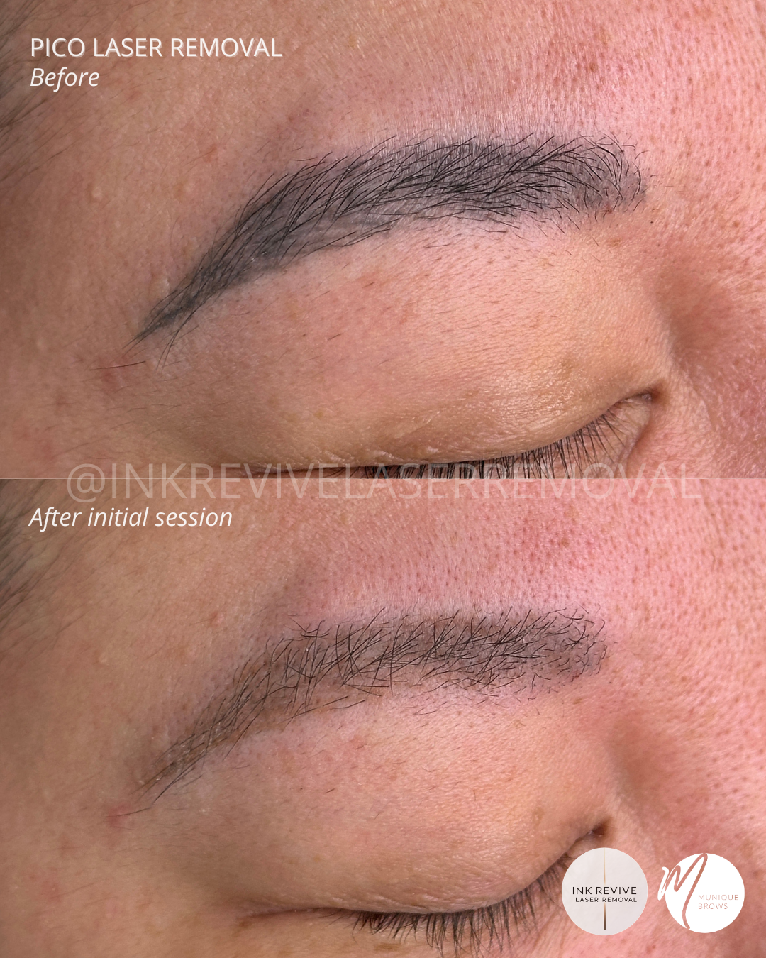 Why Are My Nano Brows Still Blue After 3 Years? The Truth About Deep Implantation