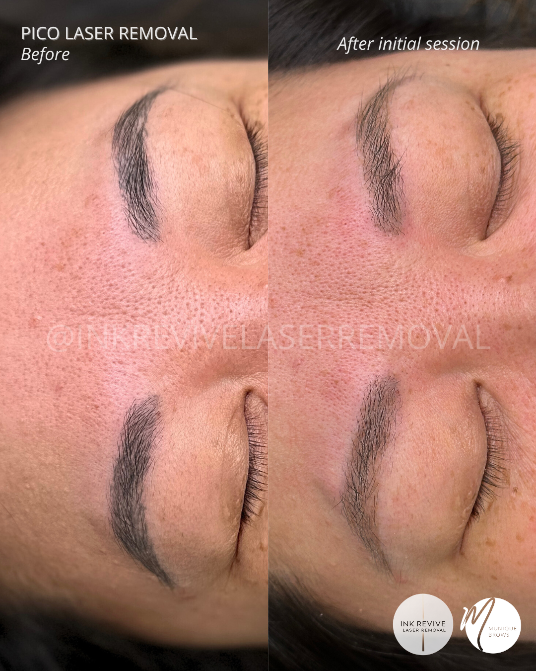 Laser removal Tam.png
