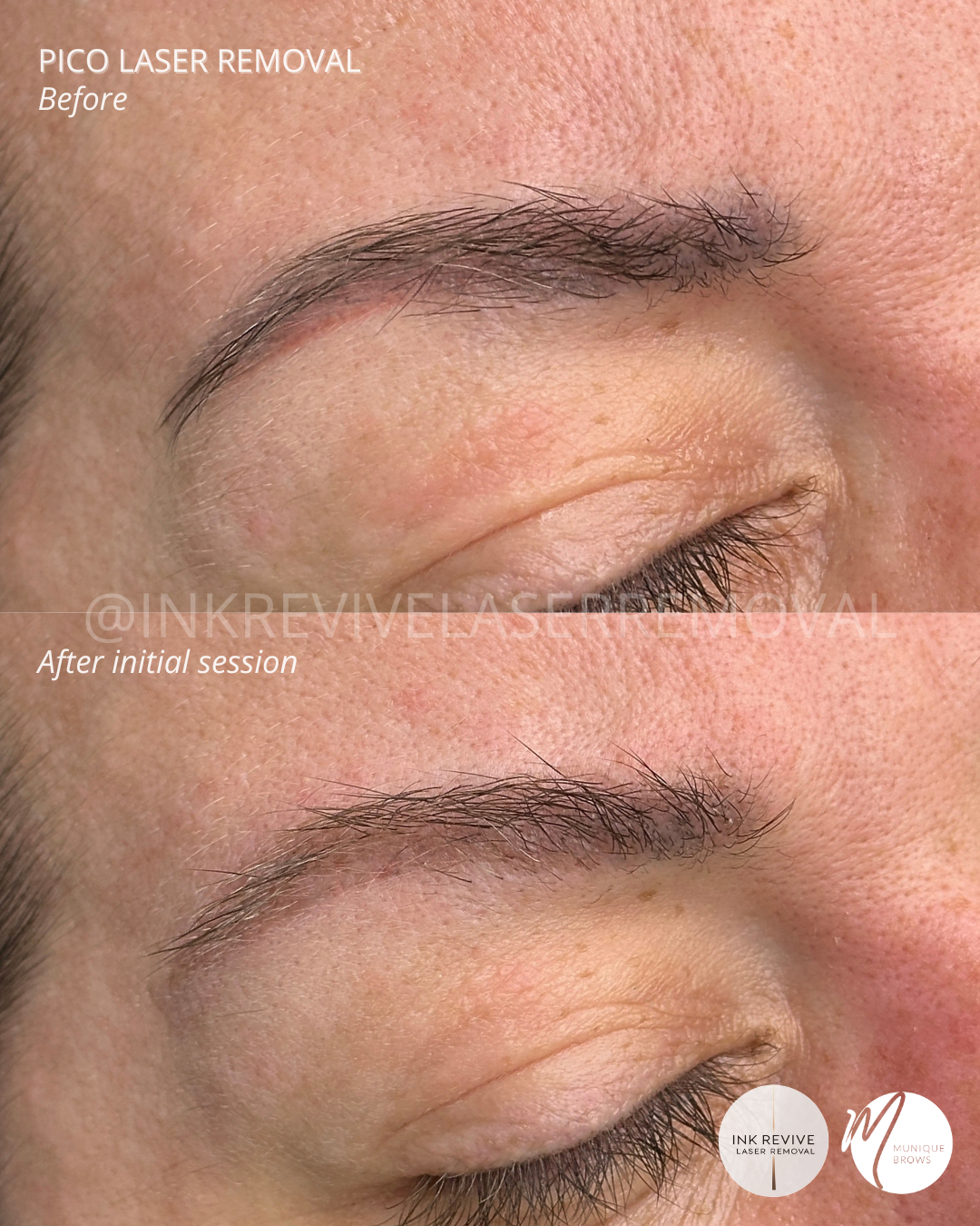 Red Residue, Begone: Why This Client Chose a "Pico Reset" for Her Brows