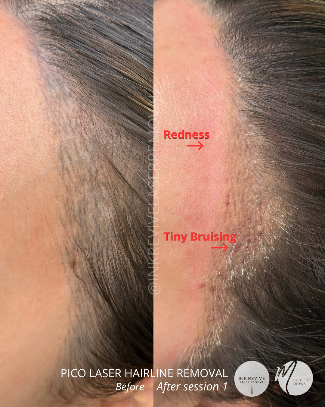 Restoring Your Confidence: Why Your SMP Hairline Isn't Looking Natural