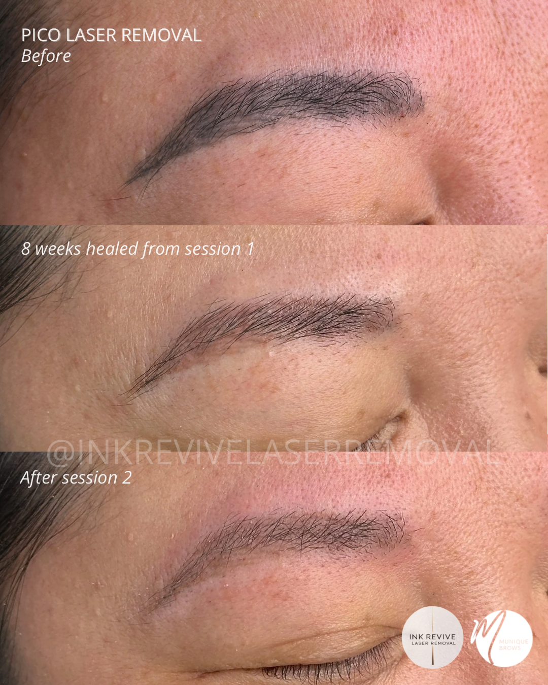 Laser removal Tam - 4.png