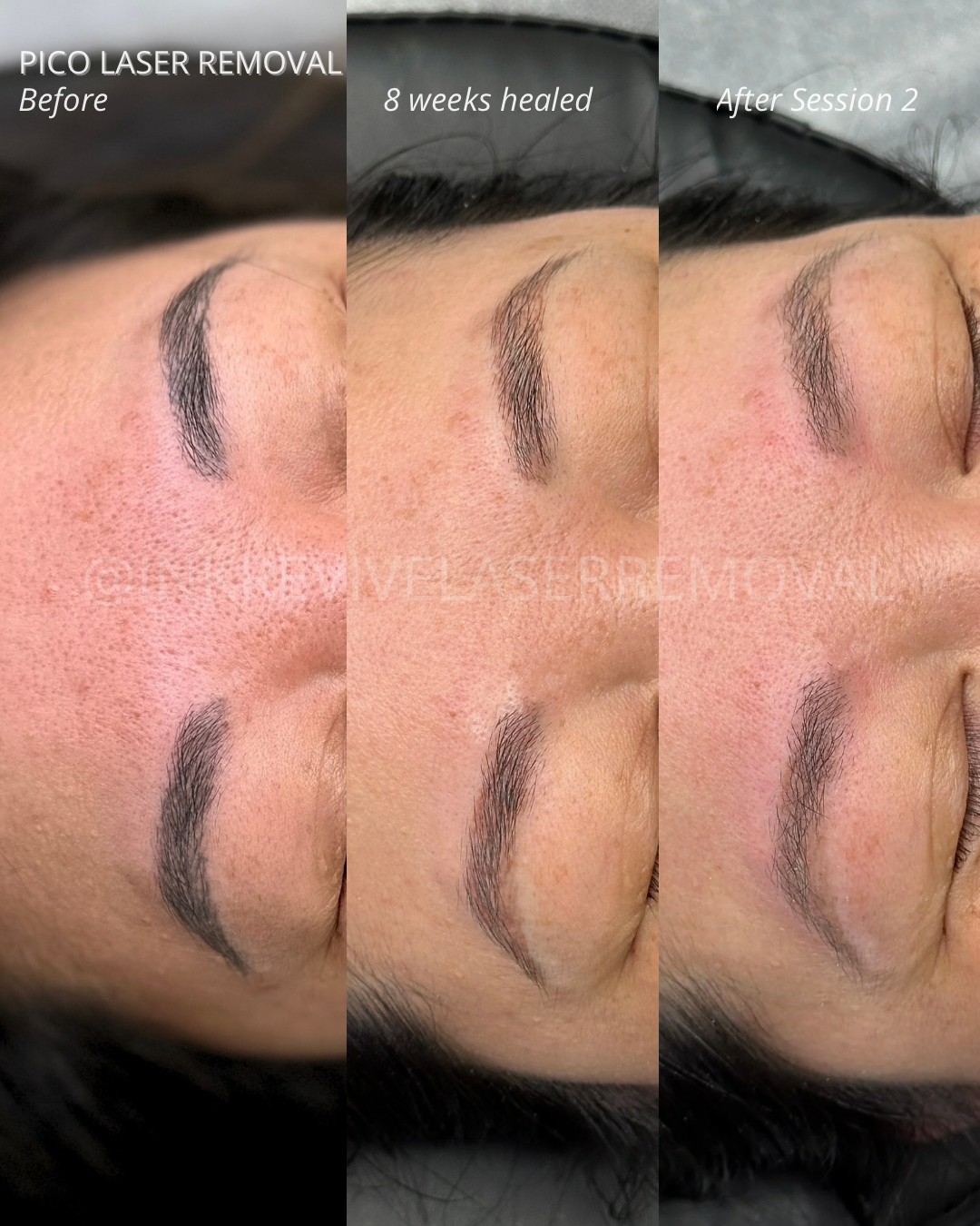 Laser removal Tam - 5.png