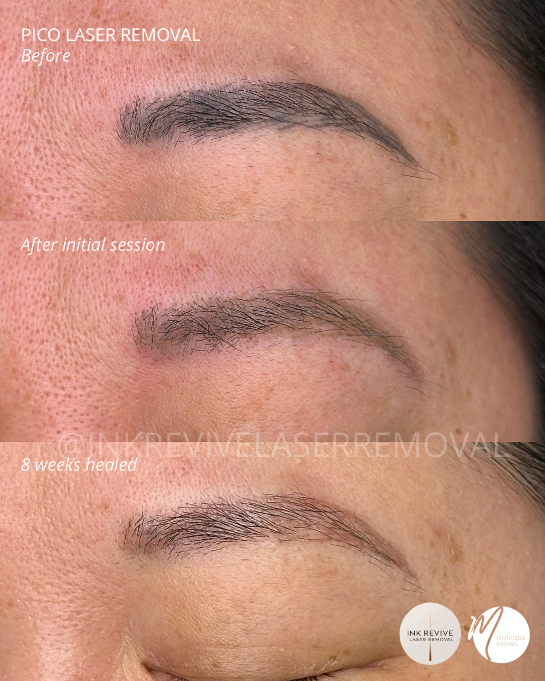 Laser removal Tam - 1.png