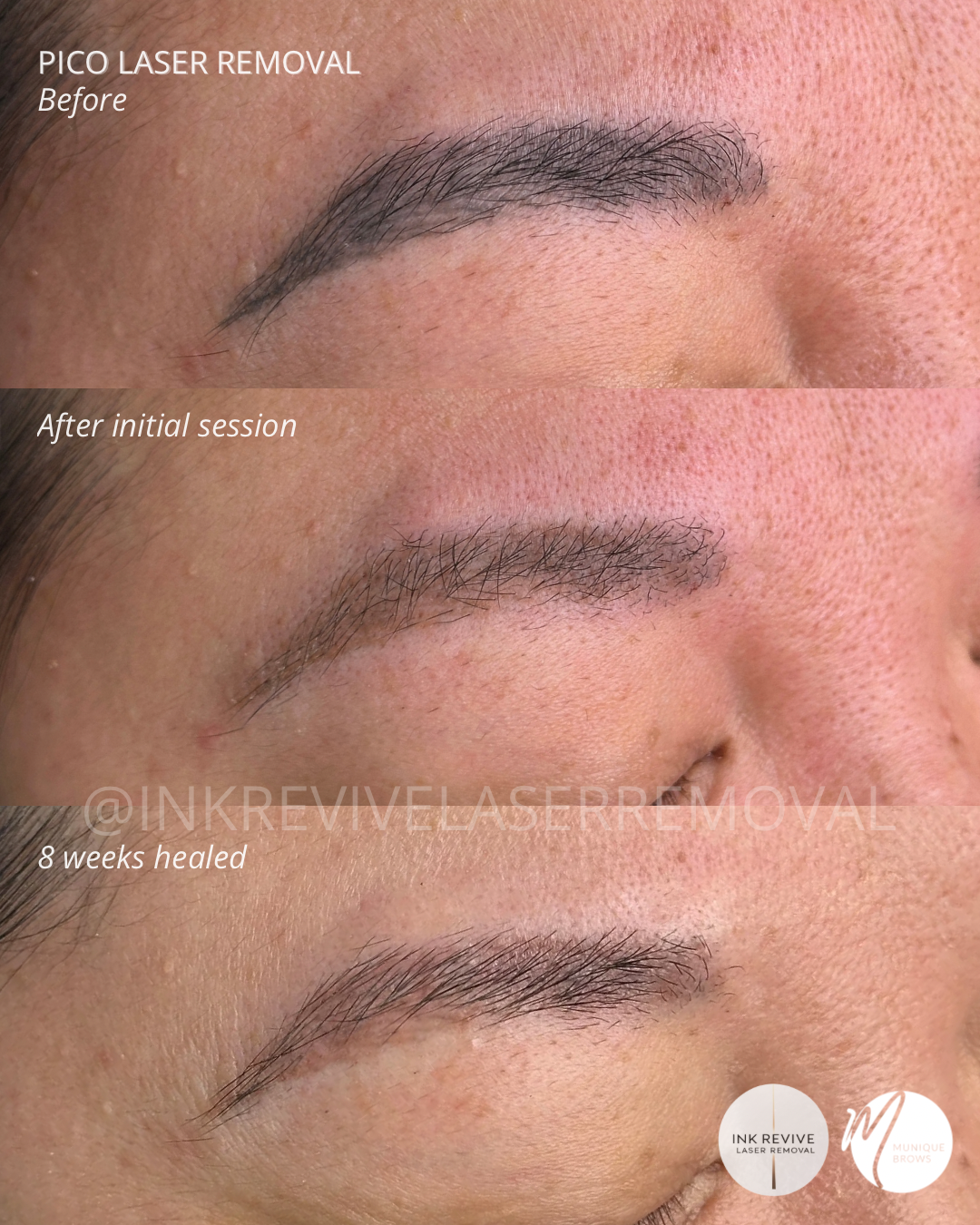 Laser removal Tam - 3.png