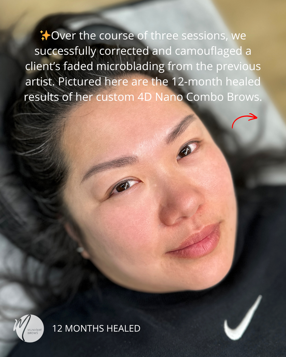 Brow Correction Sam - 2.png