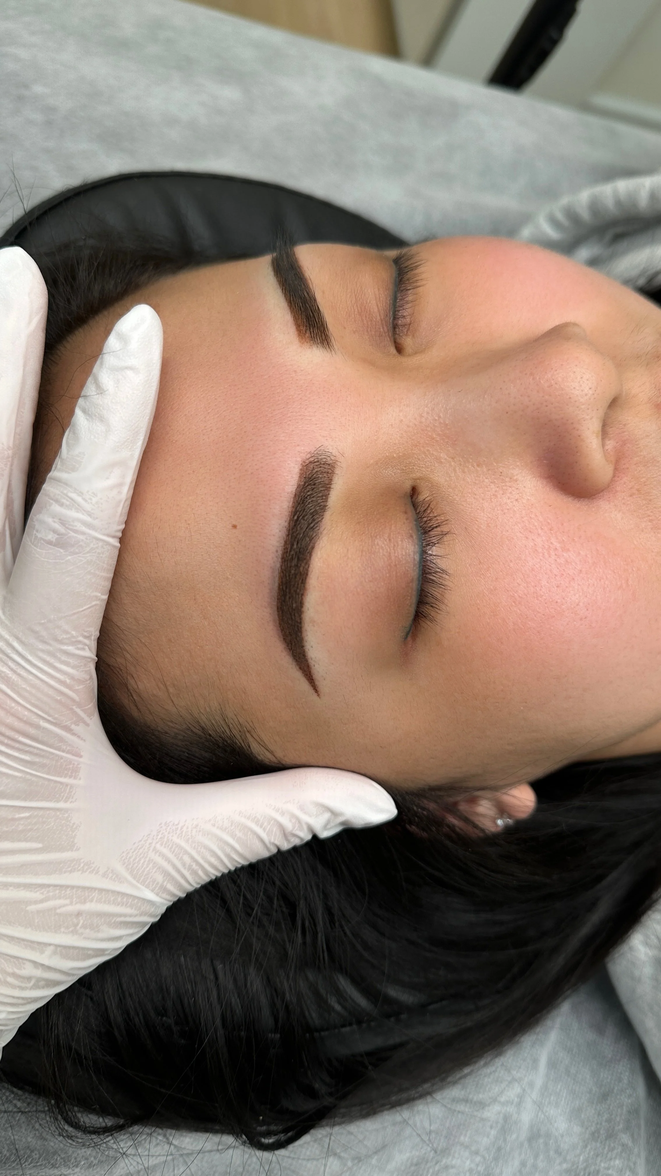 Rescuing Uneven Brows: A Case Study in Laser Correction and Color Neutralization