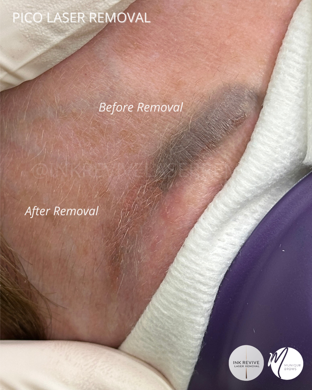 Microblading Turning Blue? How Pico Laser &amp; Powder Brows Restored This Client’s Confidence