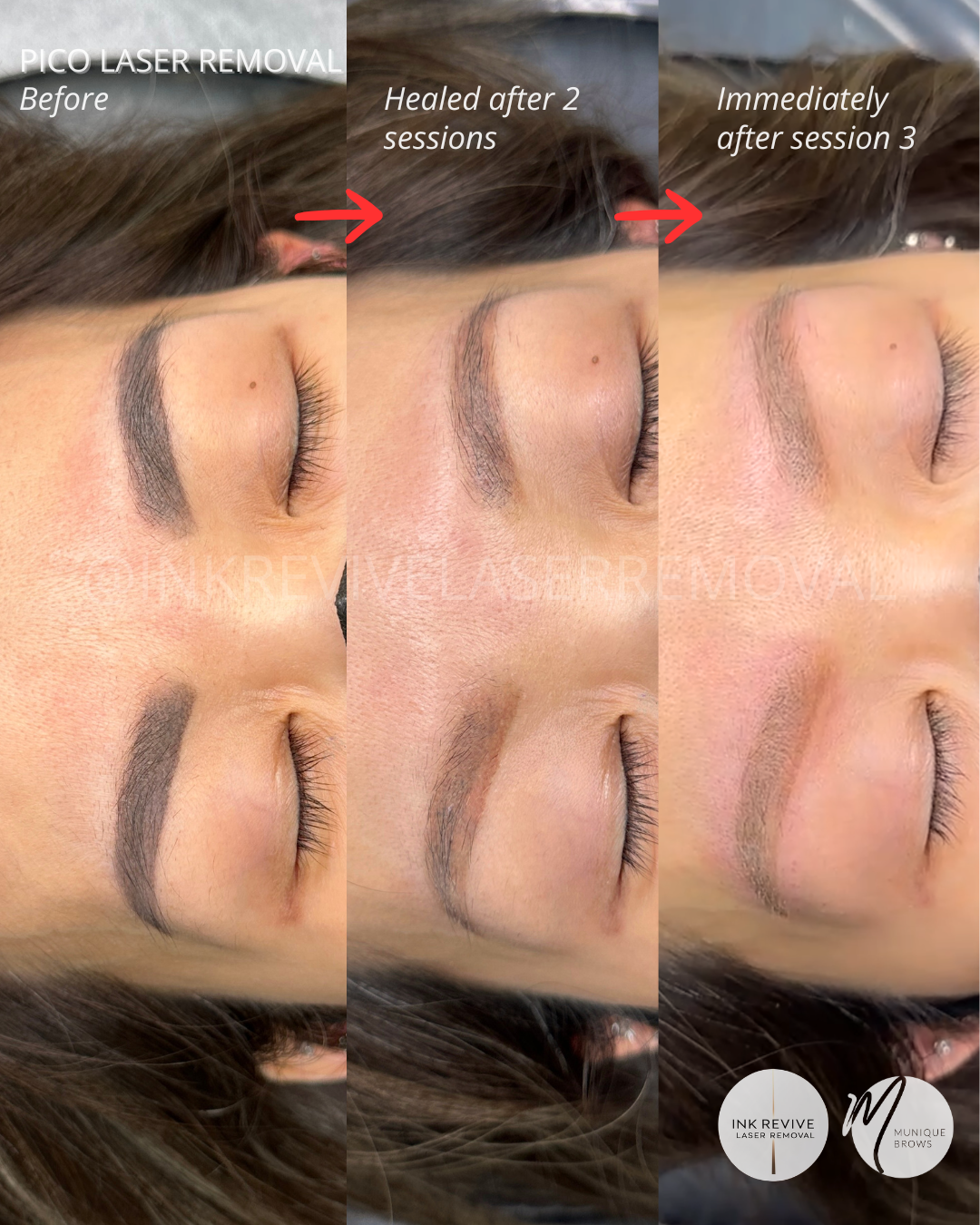 Hard, Dark Brows? How This Client Fixed a Deeply Scarred Brow Correction