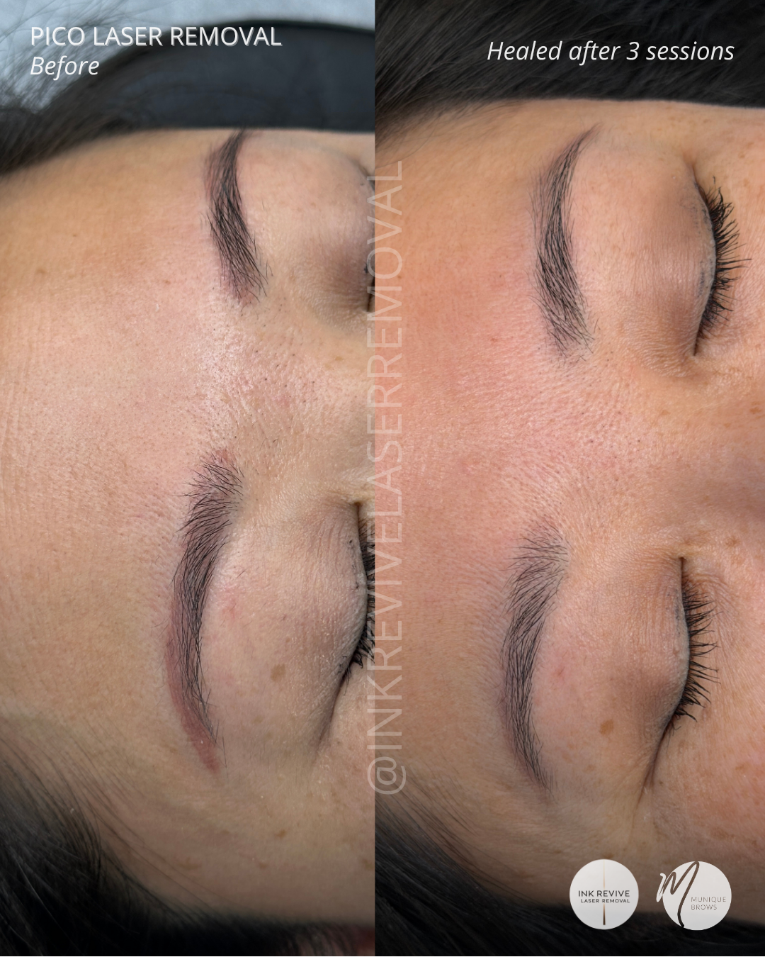Laser removal Kendra - 2.png