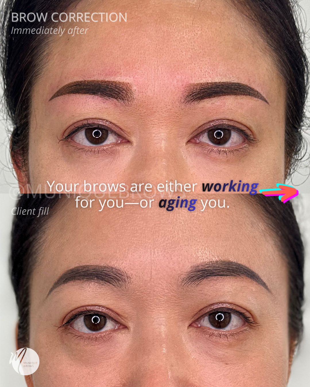 Brow Correction - 1.png