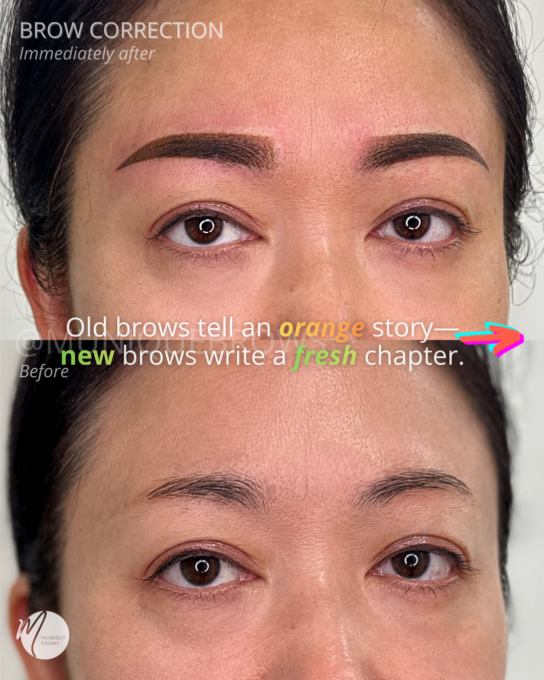 Brow Correction - 2.png