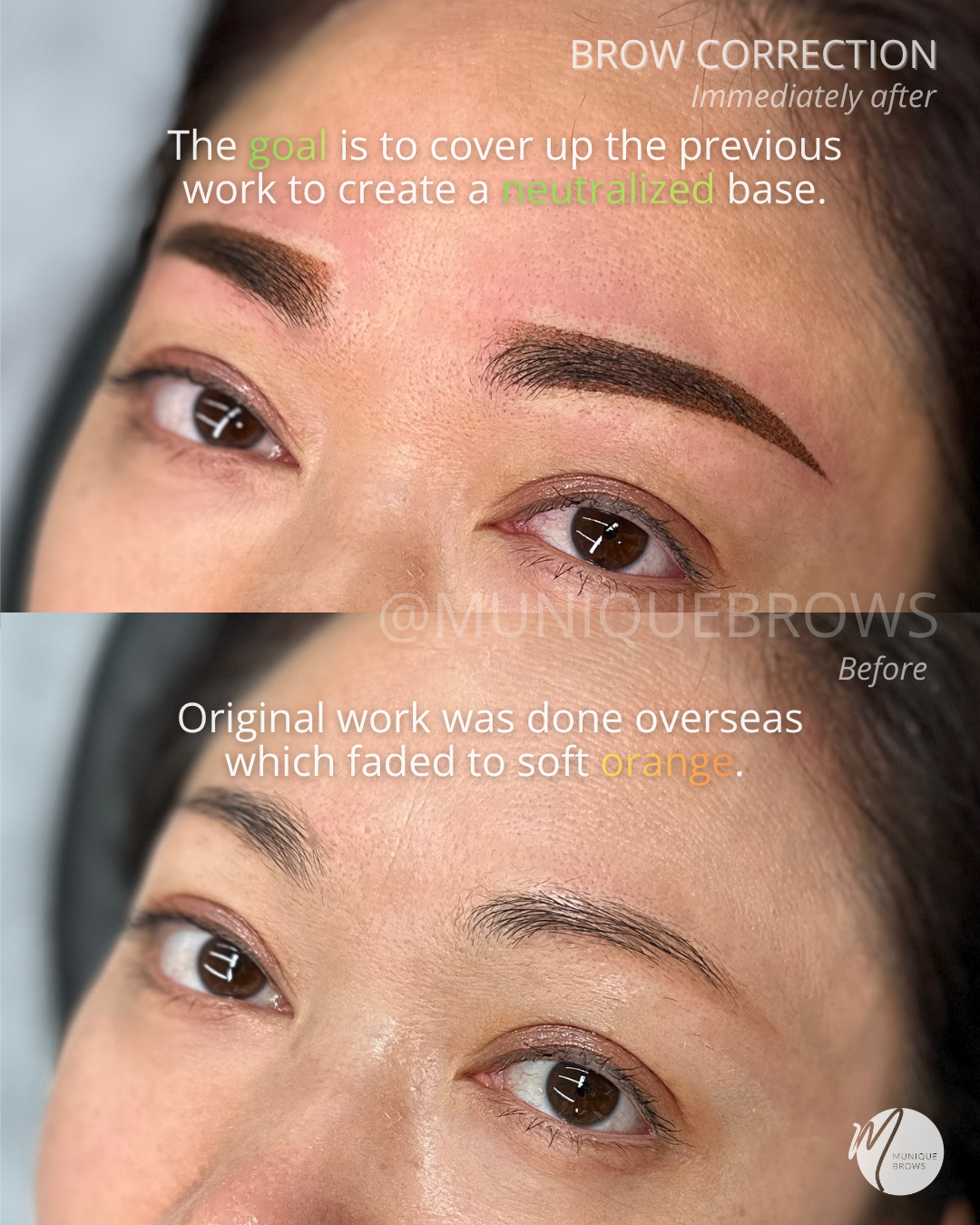 Brow Correction - 3.png