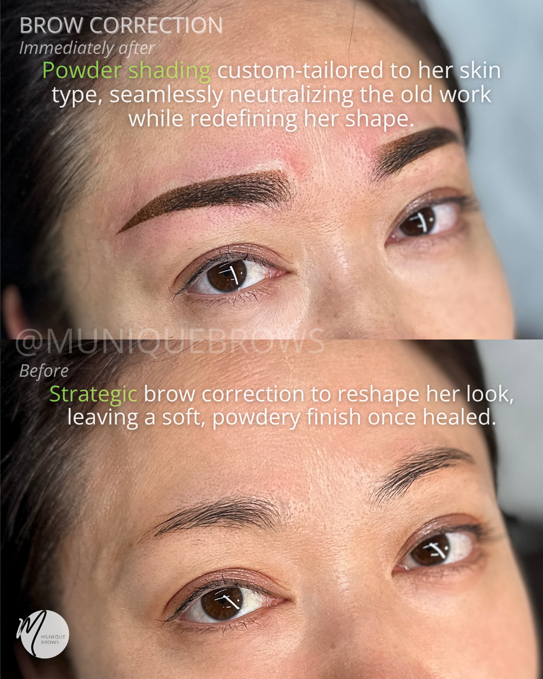 Brow Correction - 4.png