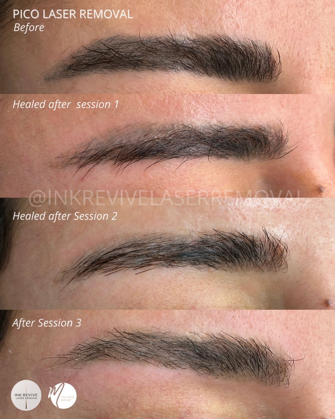 Pico laser removal G.png