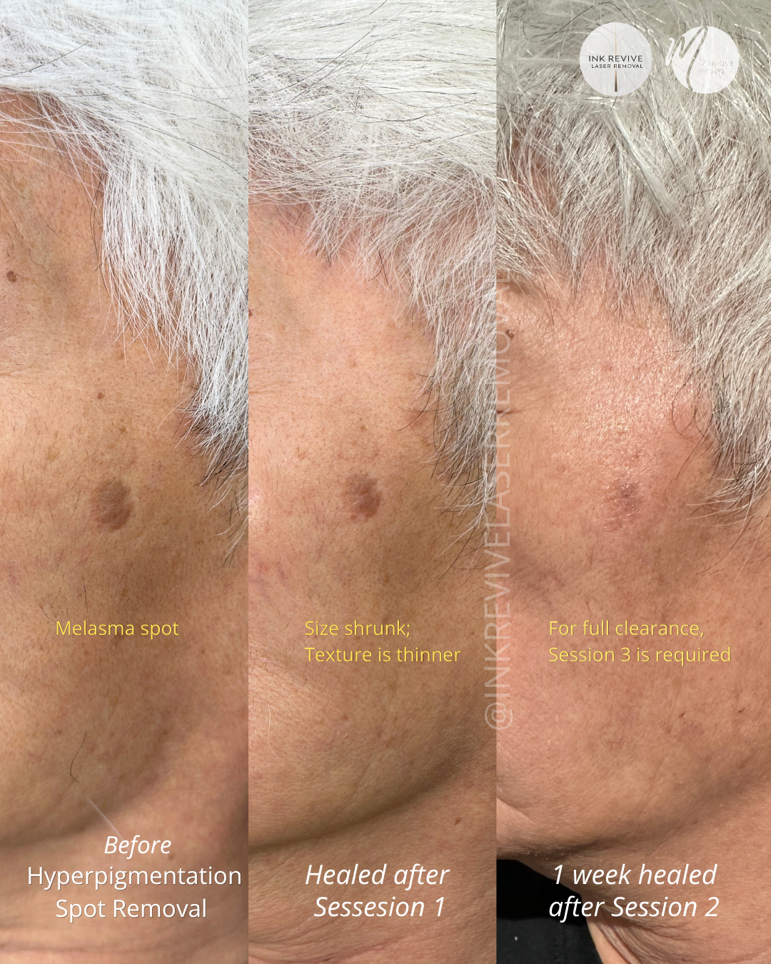 Progression of hyperpigmentation spot removal on skin over multiple treatments. The image shows three stages: before, after healed after one session, and after two sessions, with visible reduction in dark spot size and pigmentation.