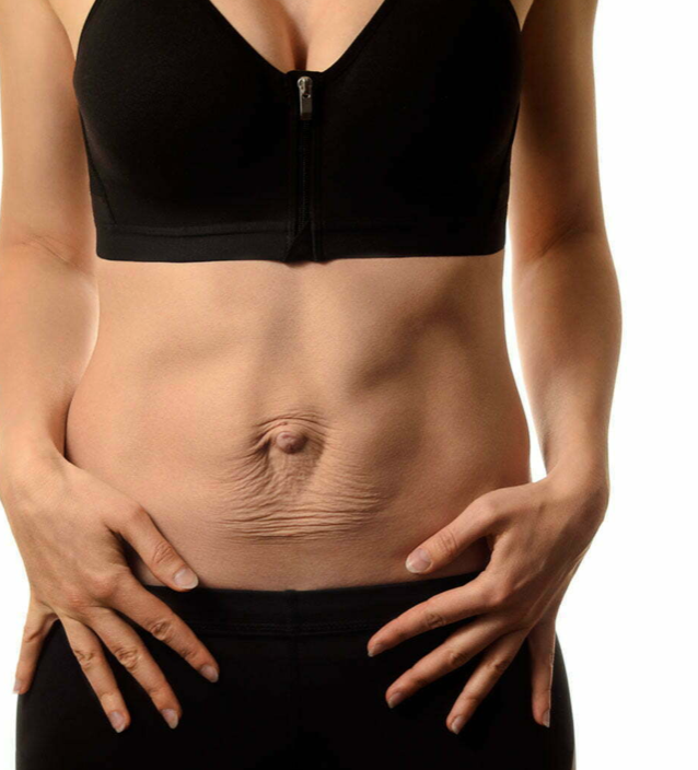 Diastasis Recti: Why do I have it?