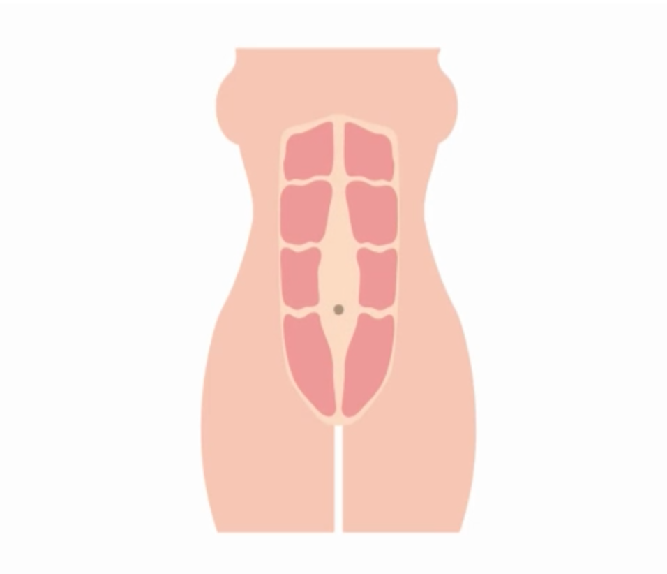 Diastasis Recti