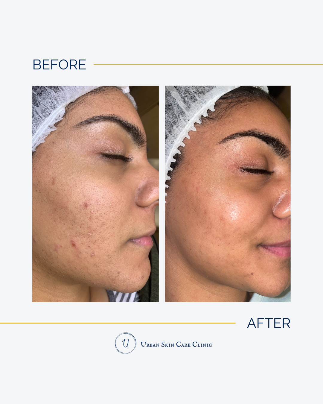 Microchanneling vs. Microneedling vs. Chemical Peels: Which Treatment Is Right for Your Skin?