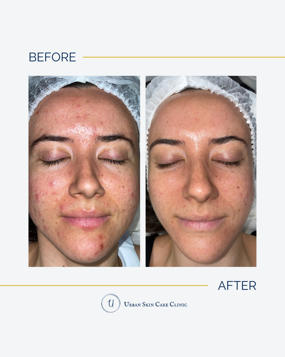 Your Roadmap To going From Acne To Makeup‑Optional Confidence in Roswell, GA.