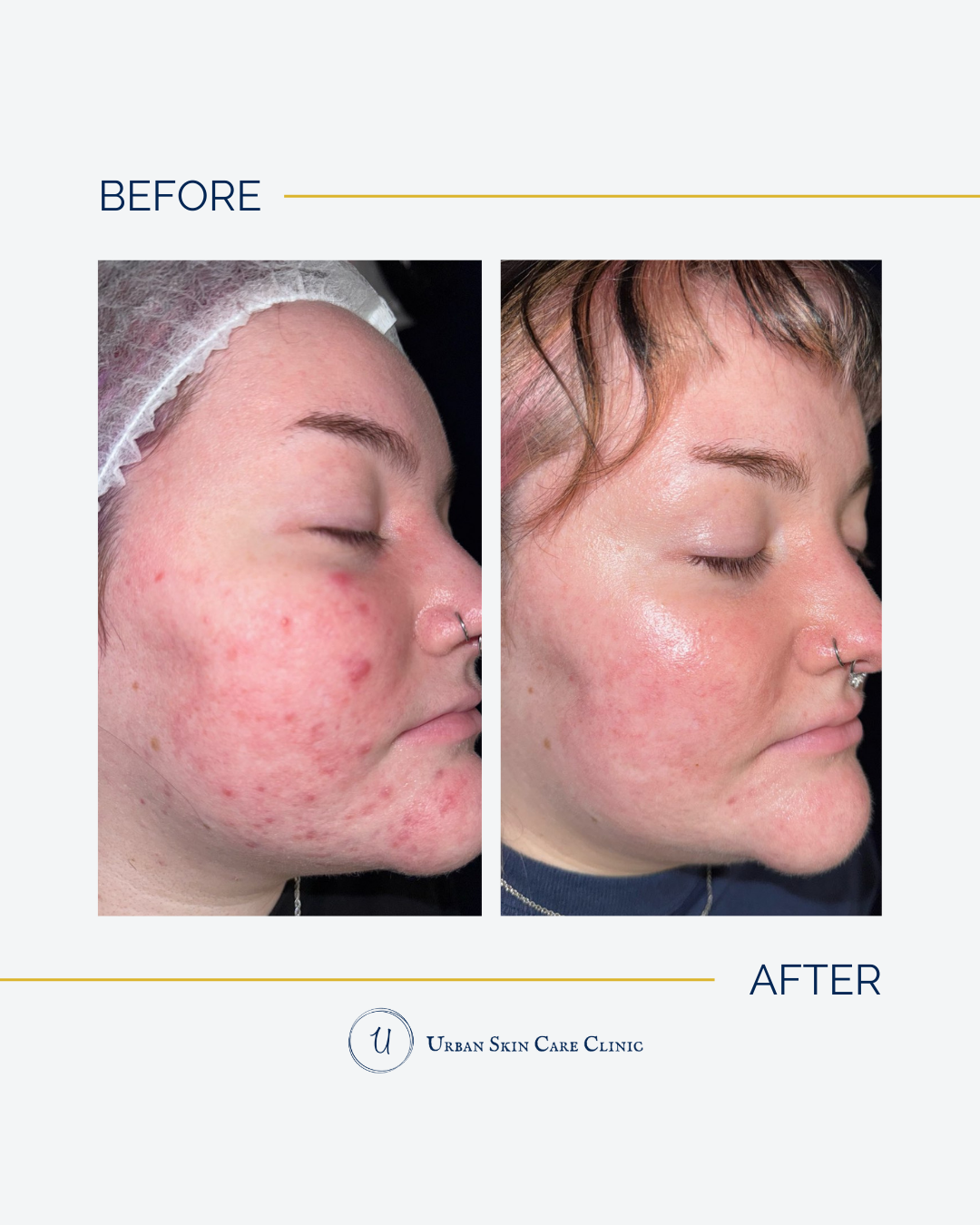 Skin Inflammation: The Root Cause No One Is Explaining to You