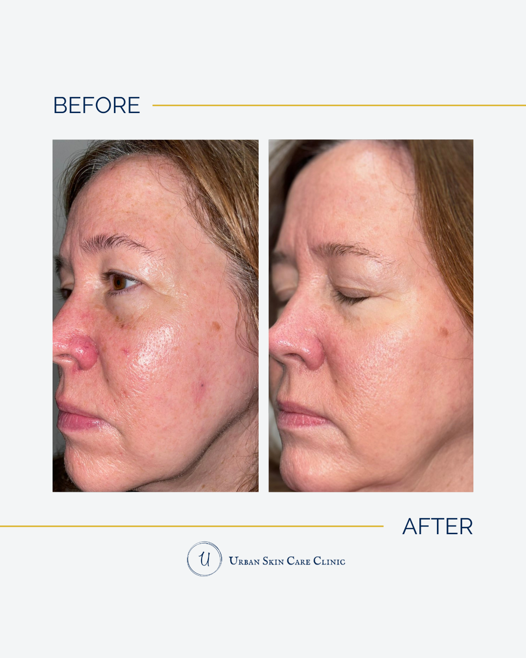 Why Your Neck, Chest, and Hands Age Faster Than Your Face